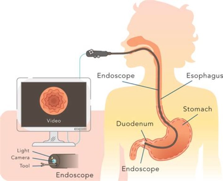 Upper GI Endoscopy Procedure | inSite Digestive Health Care